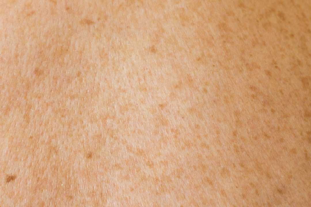 shingles rash recovery